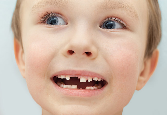 Boy showing off his missing teeth
